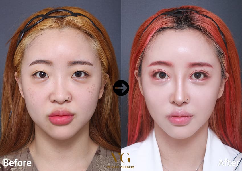 Natural-Adhesion Double Eyelid + Non-Incisional Ptosis Correction + Epicanthoplasty (Inner Corner) +2