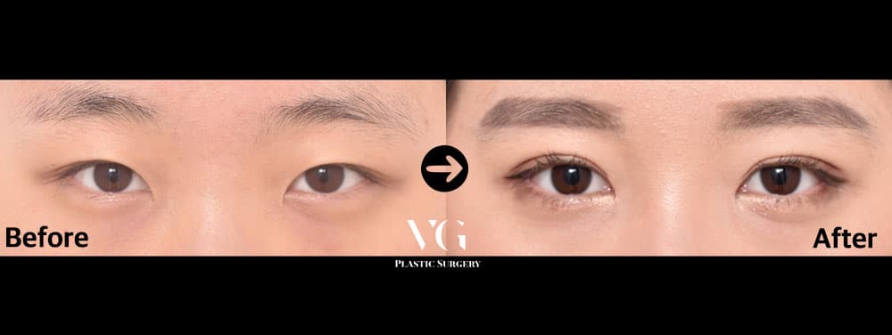 Natural-Adhesion Double Eyelid + Epicanthoplasty (Inner Corner)