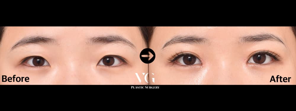Natural-Adhesion Double Eyelid + Epicanthoplasty (Inner Corner)