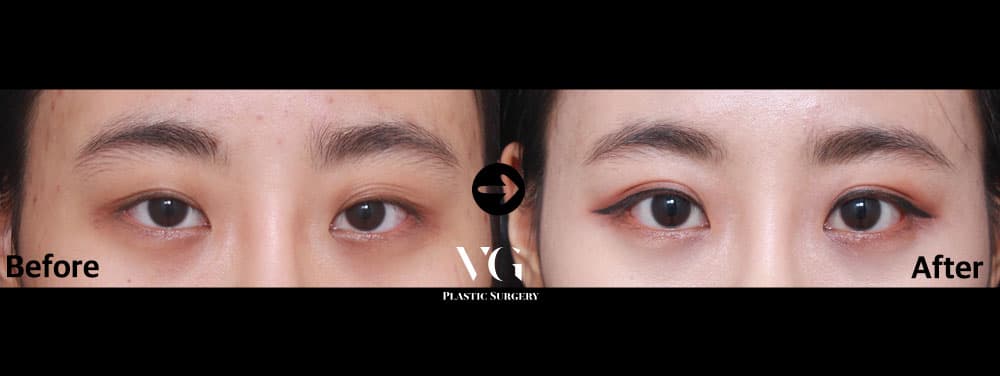Natural-Adhesion Double Eyelid + Lateral Canthoplasty (Outer Corner) + Lower Canthoplasty