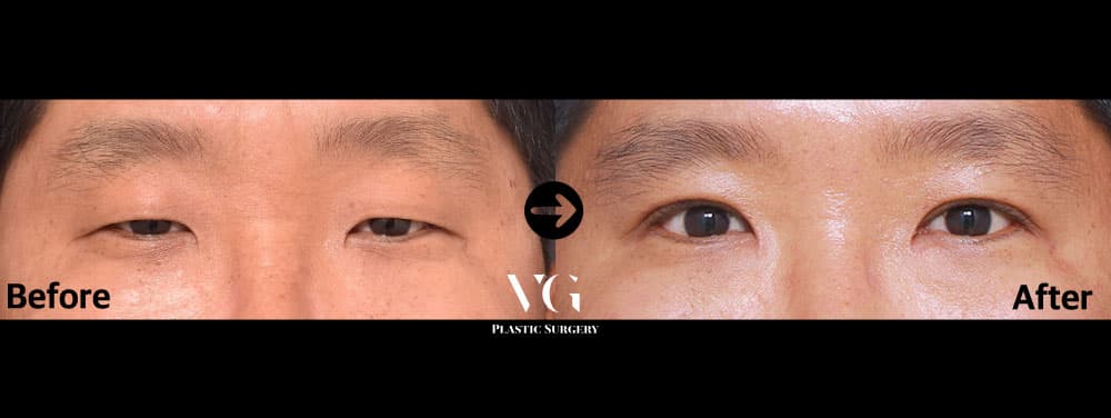 Incisional Double Eyelid + Incisional Ptosis Correction + Epicanthoplasty (Inner Corner) +1