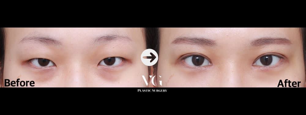 Incisional Double Eyelid + Incisional Ptosis Correction + Epicanthoplasty (Inner Corner)