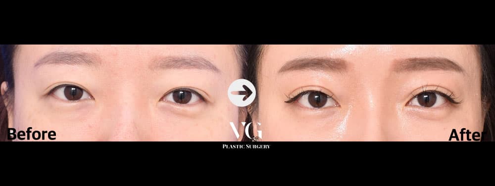 Eye Revision Surgery + Natural-Adhesion Double Eyelid