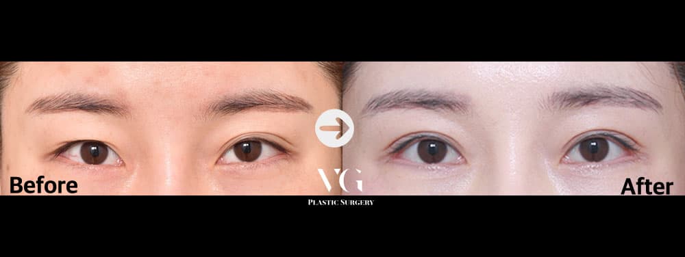 Eye Revision Surgery + Incisional Double Eyelid + Lateral Canthoplasty (Outer Corner) +2