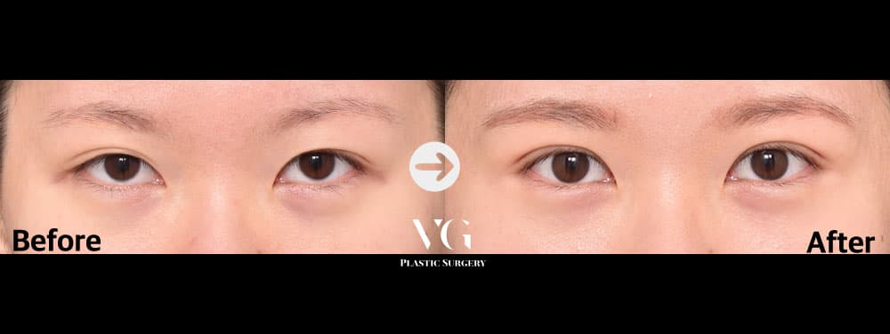 Eye Revision Surgery + Natural-Adhesion Double Eyelid