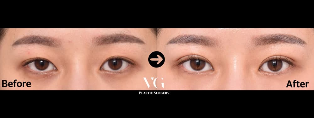 Eye Revision Surgery + Natural-Adhesion Double Eyelid