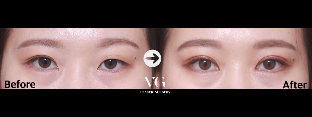 Natural-Adhesion Double Eyelid + Non-Incisional Ptosis Correction + Epicanthoplasty (Inner Corner)
