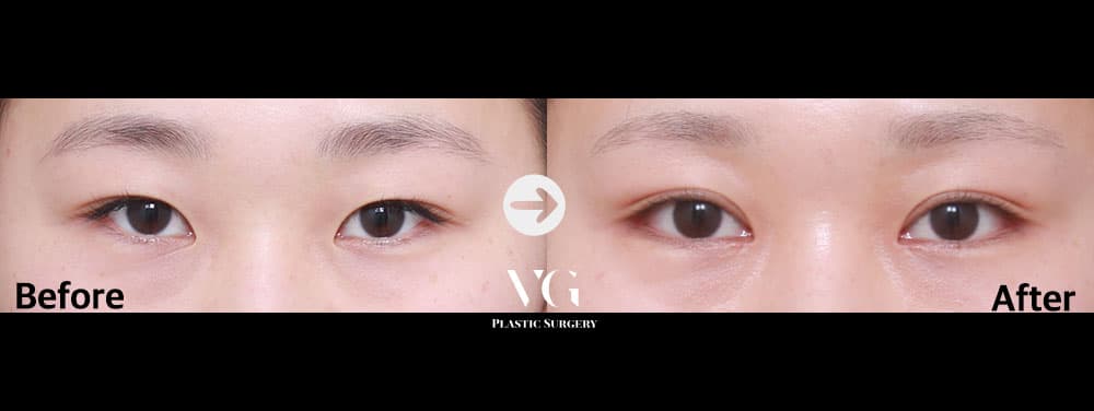 Natural-Adhesion Double Eyelid + Epicanthoplasty (Inner Corner) + Lateral Canthoplasty (Outer Corner) +1