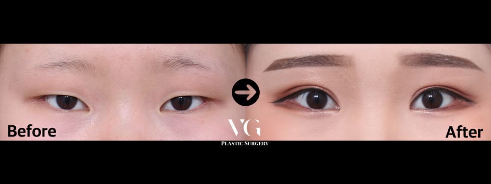 Incisional Double Eyelid + Incisional Ptosis Correction + Lateral Canthoplasty (Outer Corner) +1