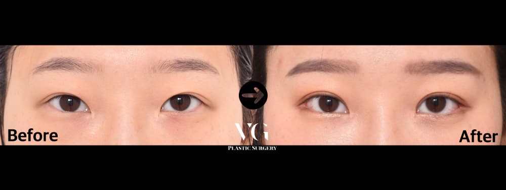 Eye Revision Surgery + Natural-Adhesion Double Eyelid