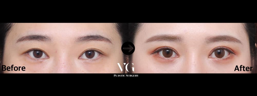 Eye Revision Surgery + Incisional Double Eyelid + Incisional Ptosis Correction +2
