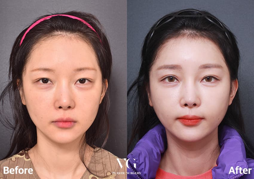 Eye Revision Surgery + Incisional Double Eyelid + Incisional Ptosis Correction