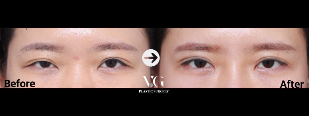 Eye Revision Surgery + Incisional Double Eyelid + Incisional Ptosis Correction