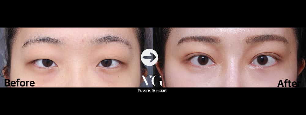 Natural-Adhesion Double Eyelid + Non-Incisional Ptosis Correction + Epicanthoplasty (Inner Corner) +2