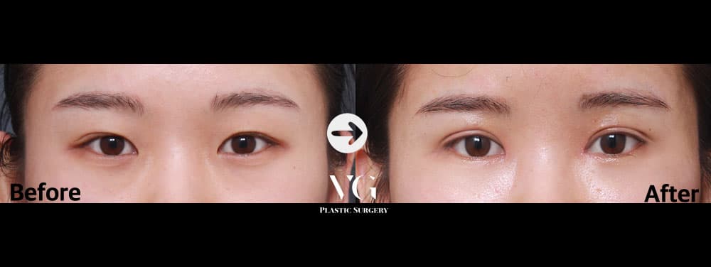 Eye Revision Surgery + Incisional Double Eyelid + Incisional Ptosis Correction +1