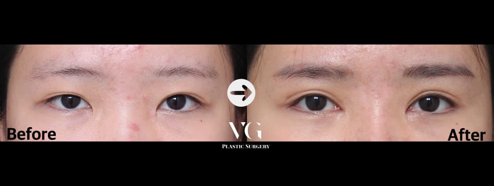 Eye Revision Surgery + Incisional Double Eyelid + Incisional Ptosis Correction +3