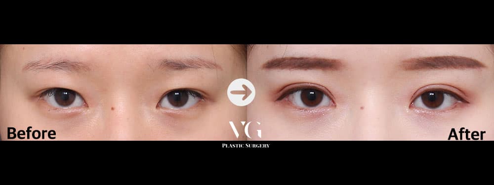 Eye Revision Surgery + Incisional Double Eyelid + Incisional Ptosis Correction +2