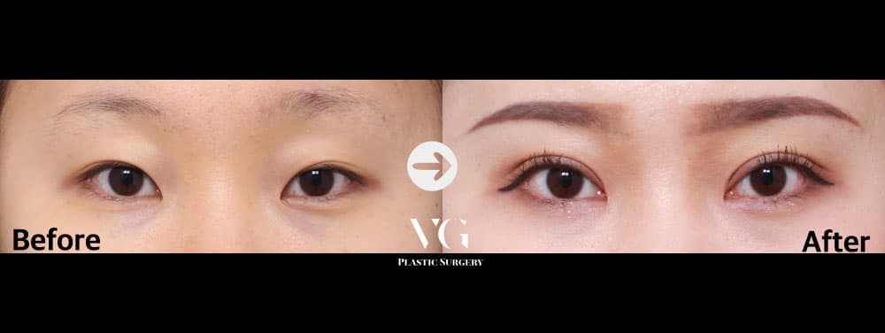 Incisional Double Eyelid + Incisional Ptosis Correction + Epicanthoplasty (Inner Corner) +2