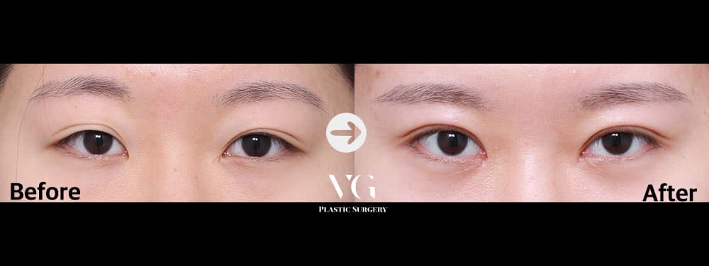 Eye Revision Surgery + Incisional Double Eyelid + Incisional Ptosis Correction +1
