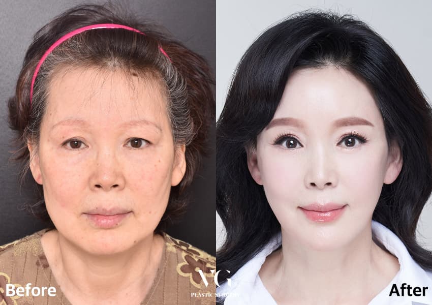 Eye surgery before and after — case 737