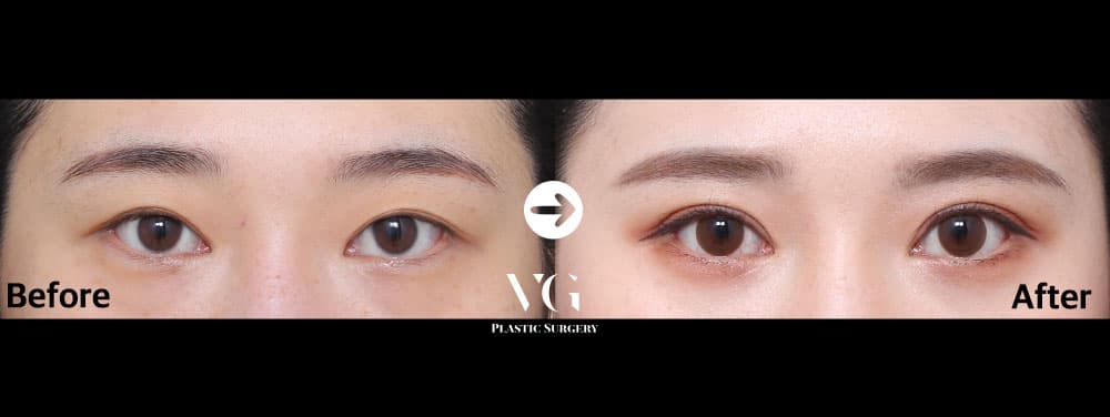 Eye Revision Surgery + Incisional Double Eyelid + Incisional Ptosis Correction +2