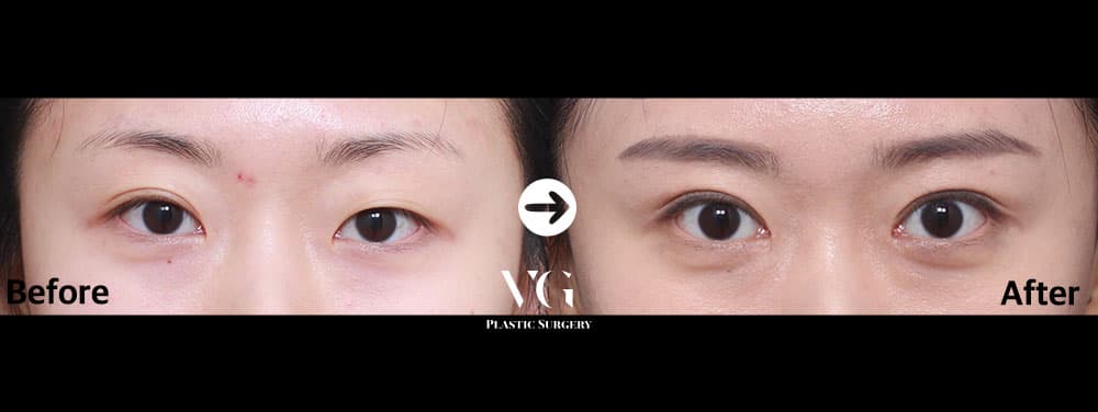 Eye Revision Surgery + Incisional Double Eyelid + Incisional Ptosis Correction +1