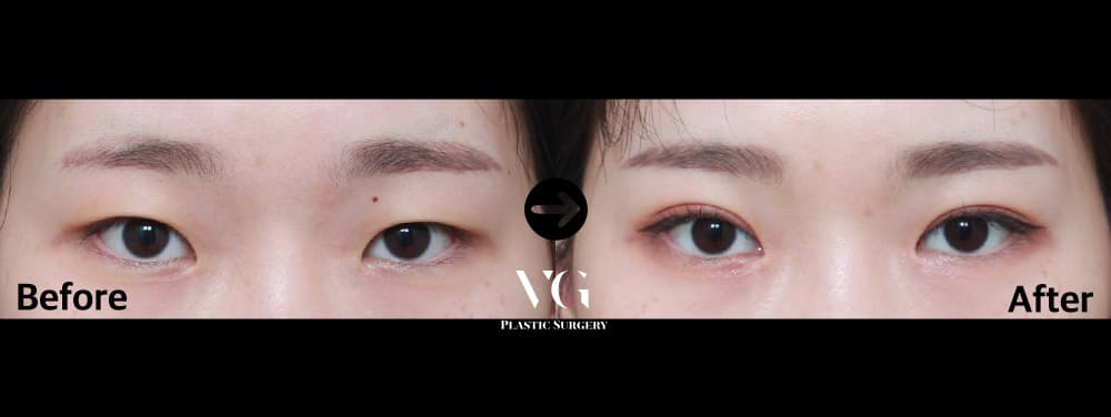 Natural-Adhesion Double Eyelid + Non-Incisional Ptosis Correction + Epicanthoplasty (Inner Corner)