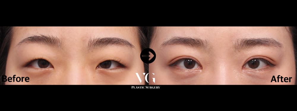 Eyes before and after — drag to compare