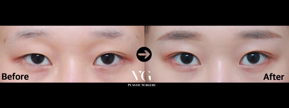 Eyes before and after — drag to compare