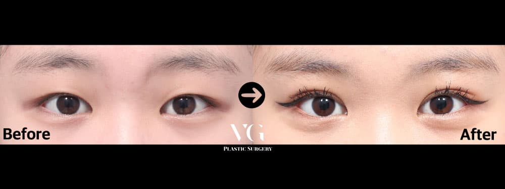 Eyes before and after — drag to compare