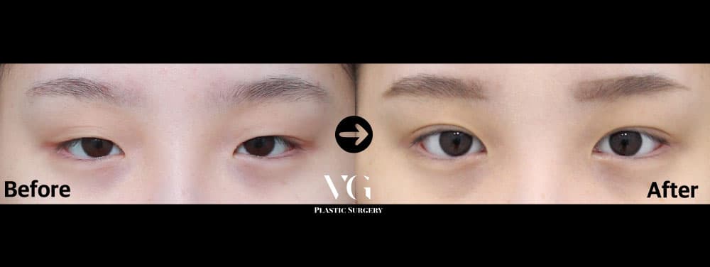 Eyes before and after — drag to compare