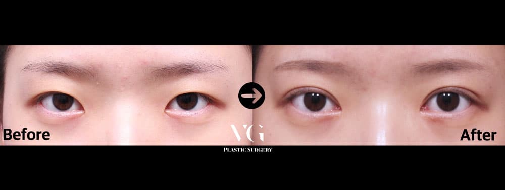 Eyes before and after — drag to compare