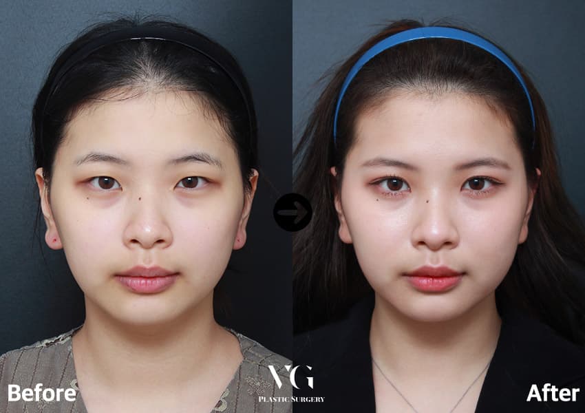 Natural-Adhesion Double Eyelid + Non-Incisional Ptosis Correction + Epicanthoplasty (Inner Corner)