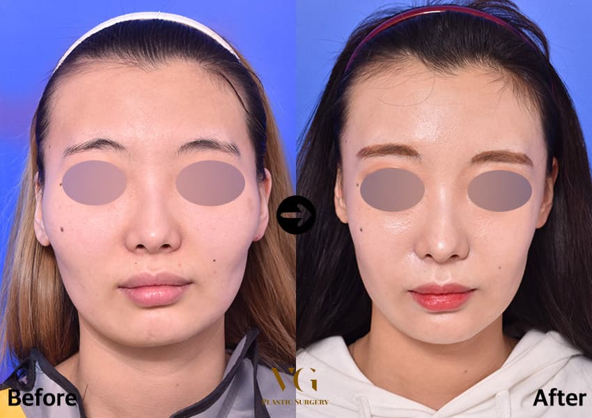 Facial contouring before and after — case 480