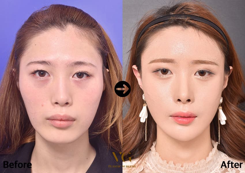 Facial contouring before and after — case 483