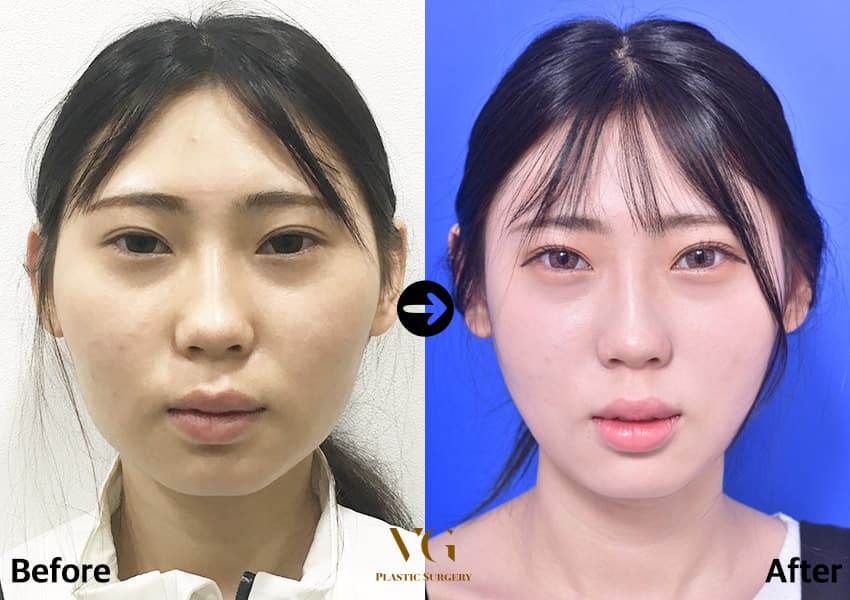Facial contouring before and after — case 490