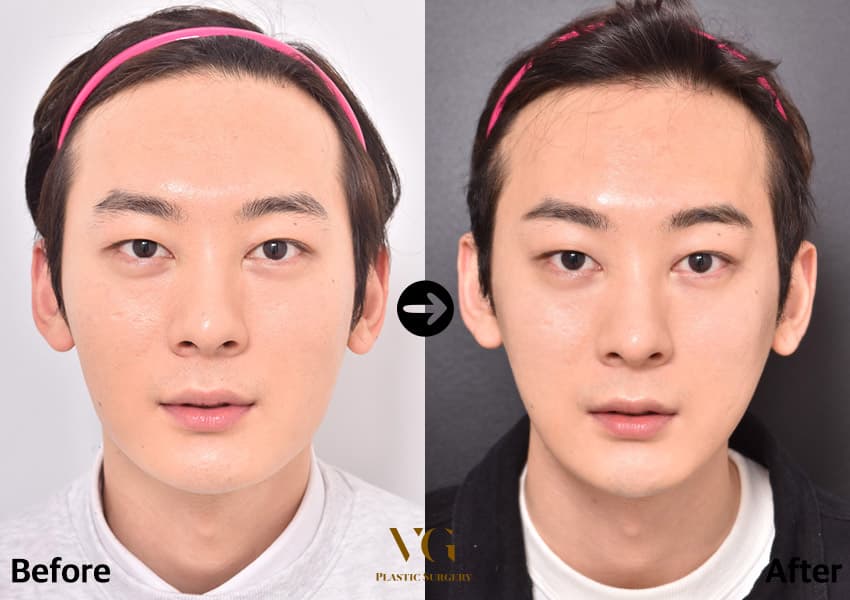Facial contouring before and after — case 491
