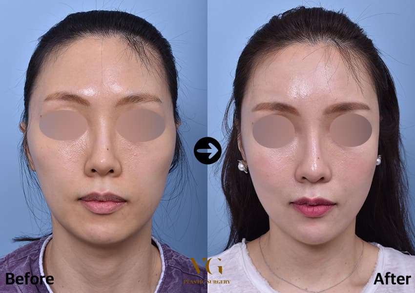 Facial contouring before and after — case 493
