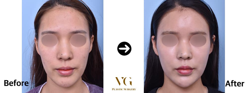 Fat grafting before and after — case 438