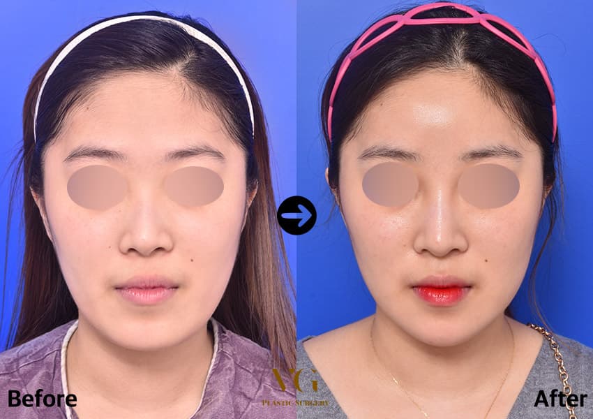 Fat grafting before and after — case 481