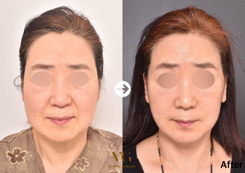 Face Lift