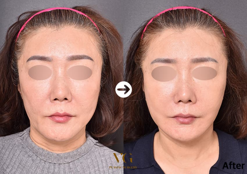 Face Lift