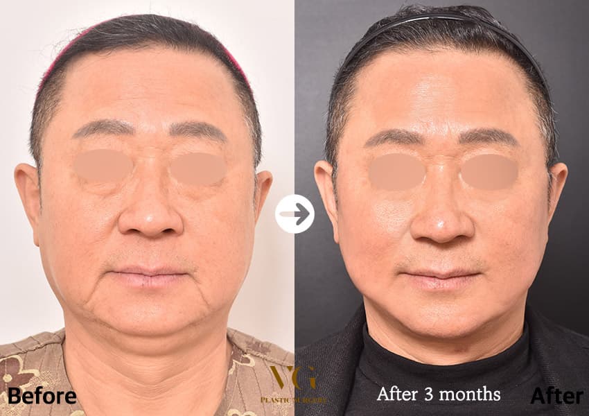 Face Lift