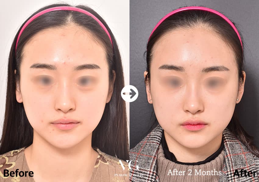 Fat grafting before and after — case 527