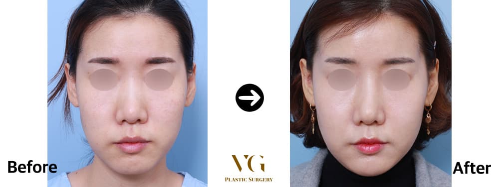 Fat grafting before and after — case 590