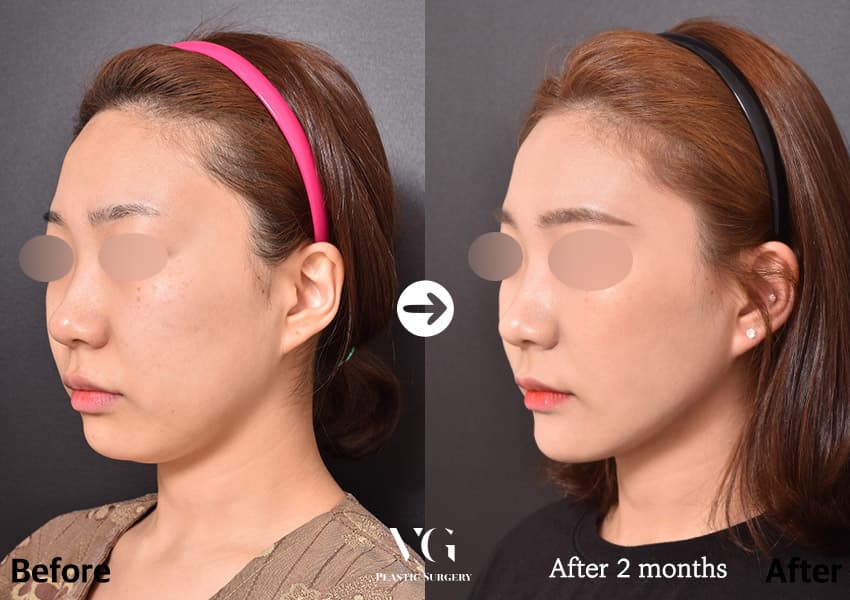 Fat grafting before and after — case 653