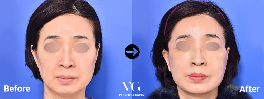 Face Lift