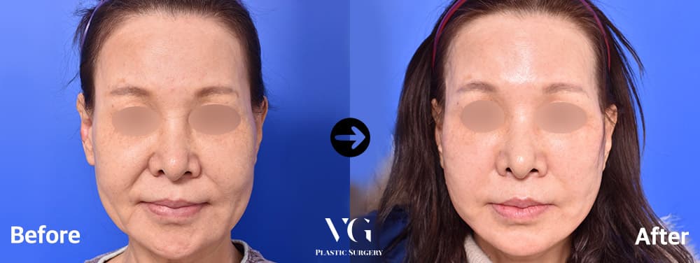 Face Lift