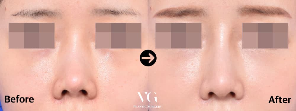 Rhinoplasty before and after — case 444