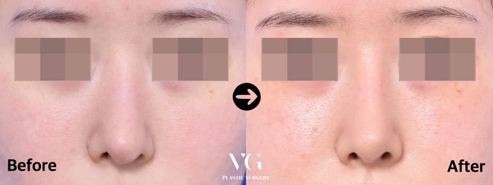 Rhinoplasty before and after — case 451